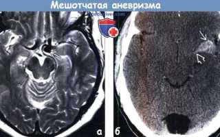 Что покажет МРТ головного мозга
